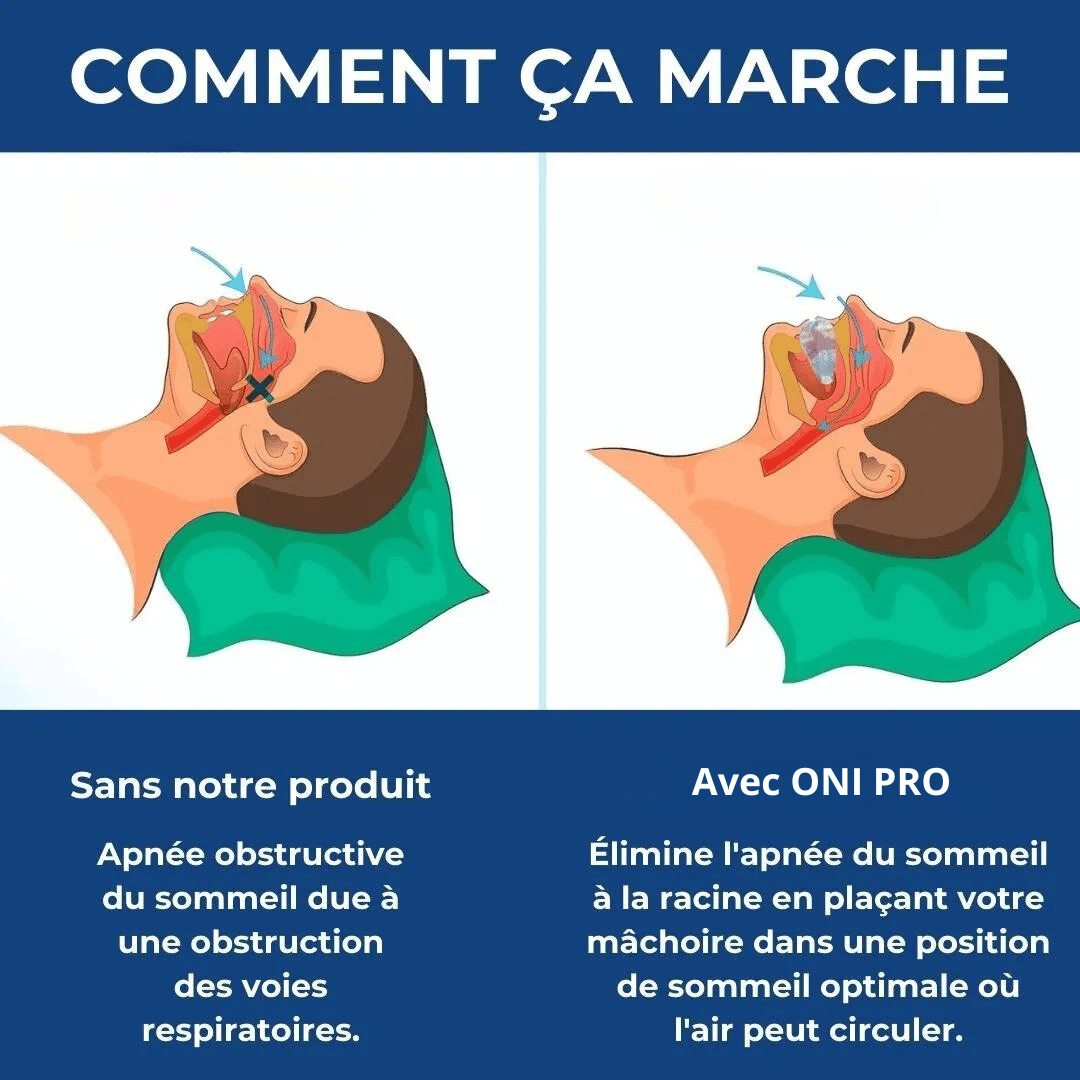 Orthèse ONI Pro contre ronflements et apnée du sommeil